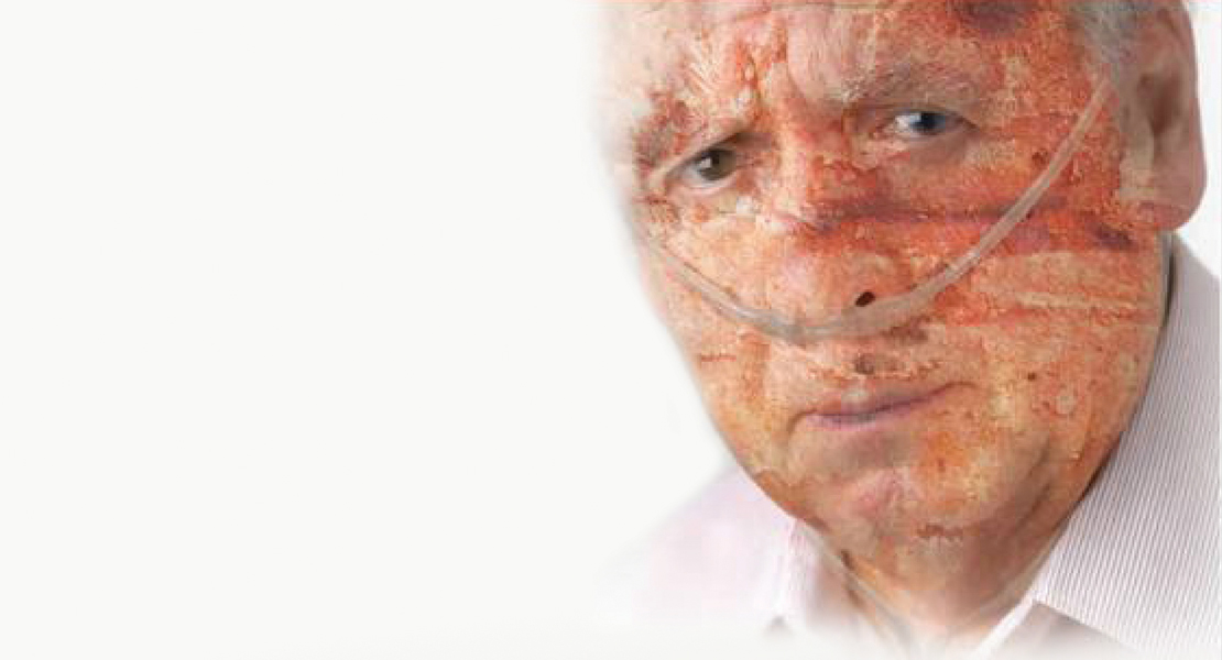 A man with a burned face wearing a nasal cannula.